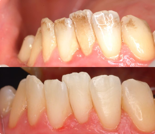 AquaCare air abrasion and air polishing at Azul Dental Center