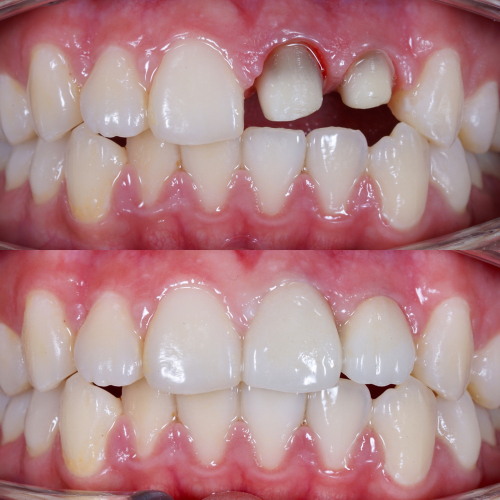 Dental crowns and bridges at Azul Dental Center