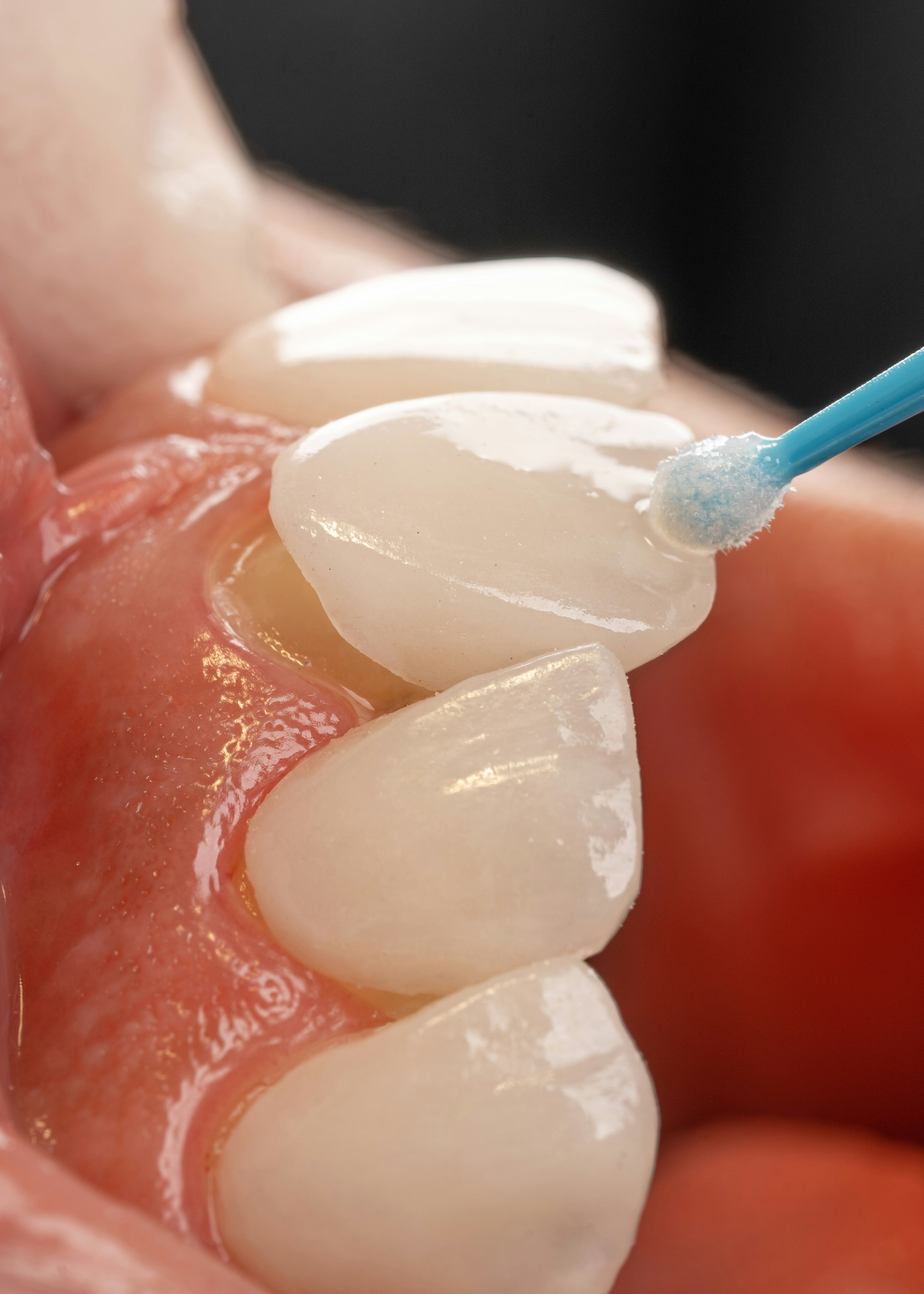 Dental veneers at Azul Dental Center