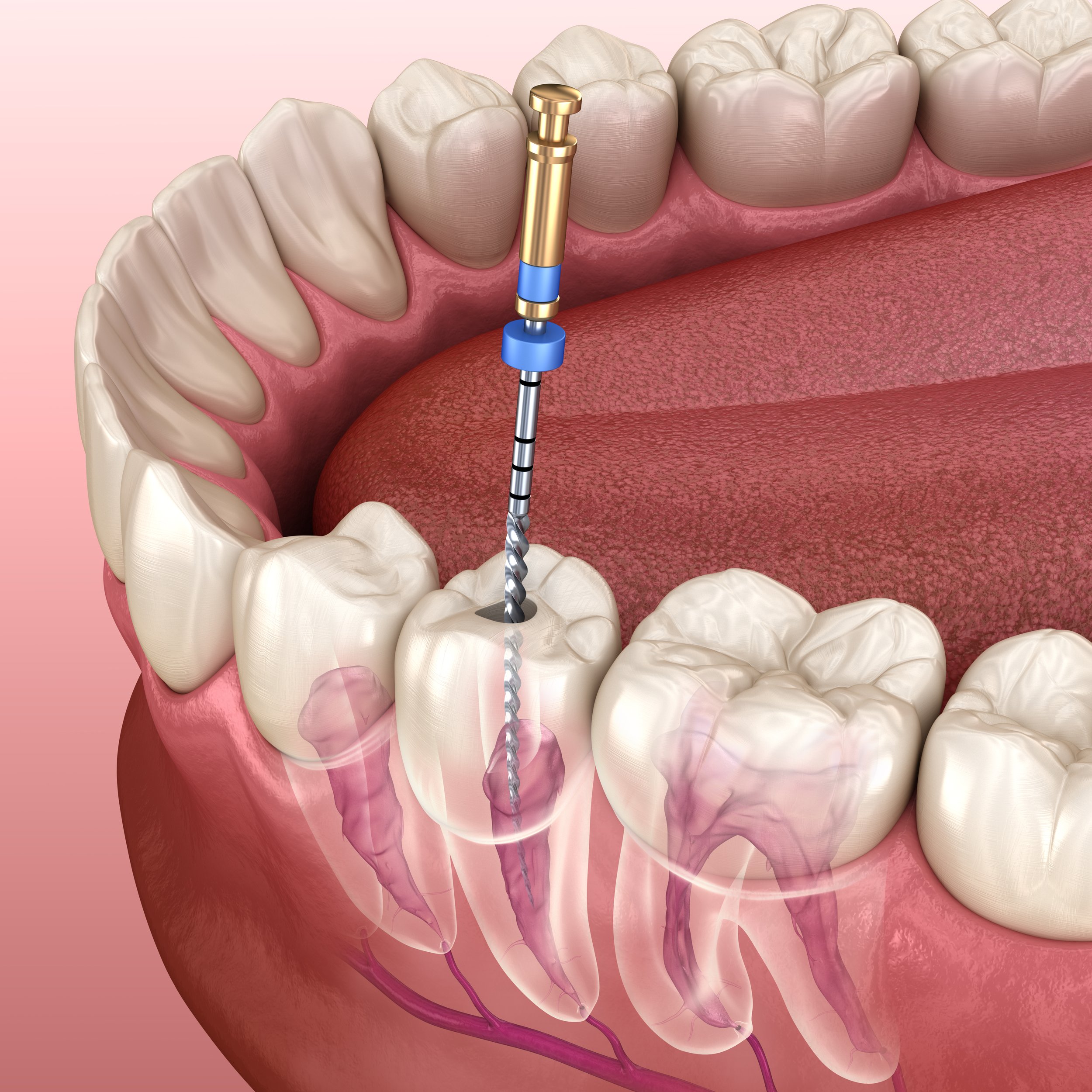 Root canal treatment at Azul Dental Center