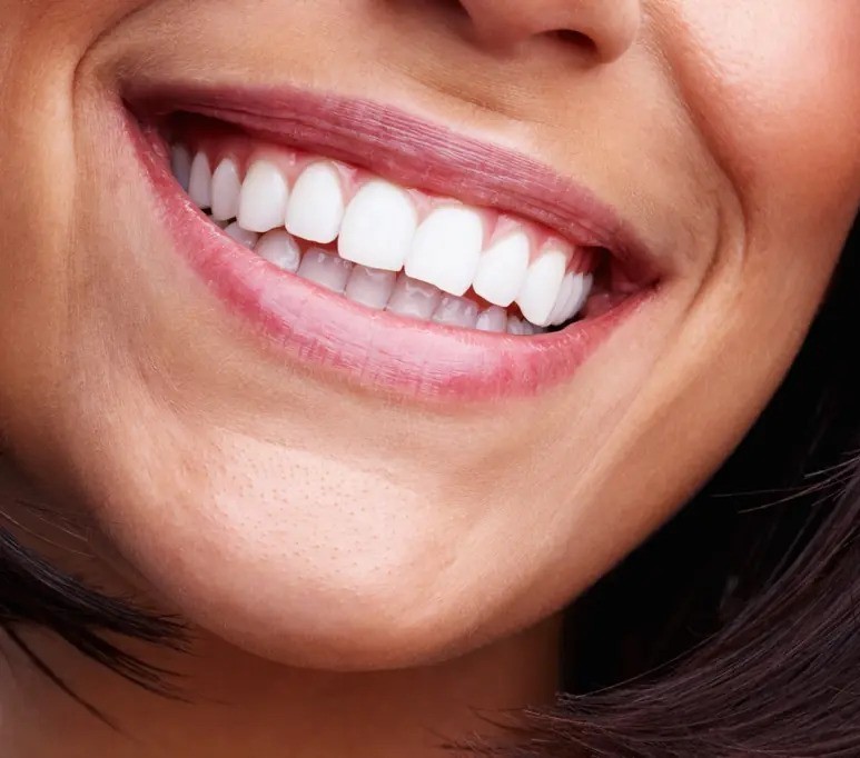 Professional teeth whitening at Azul Dental Center